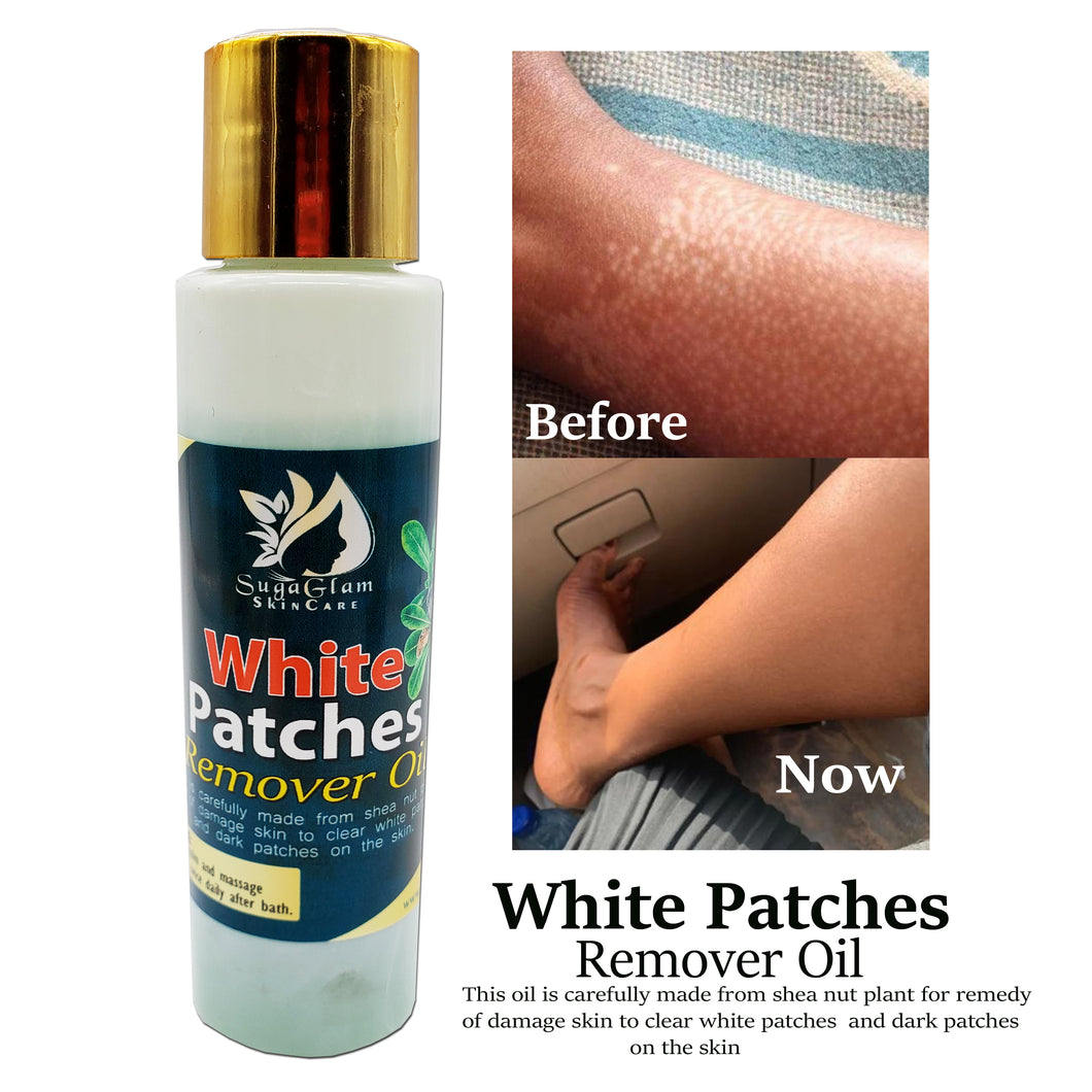 White Patches Remover Oil